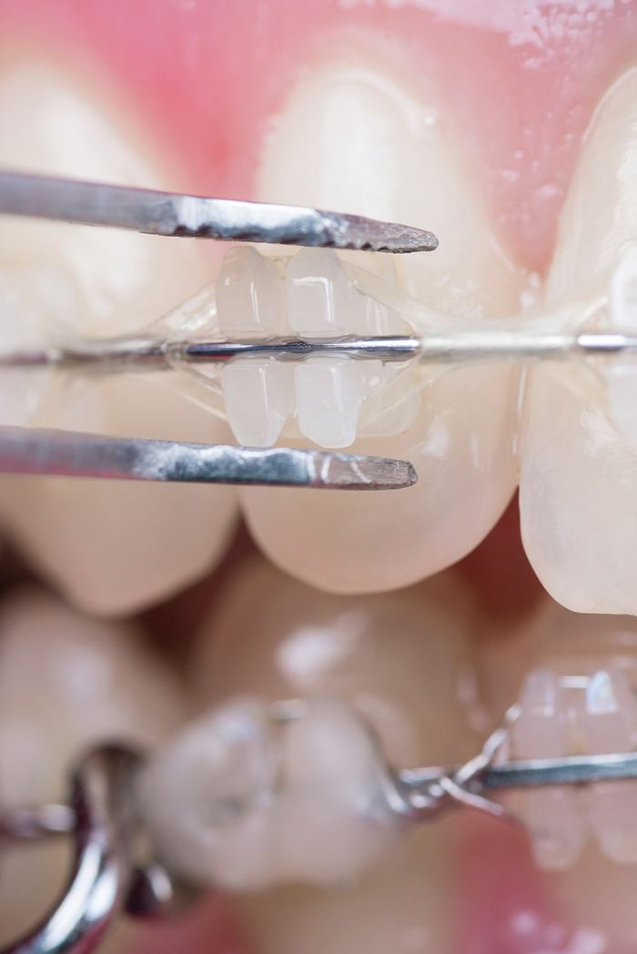 You Can Smile With Braces