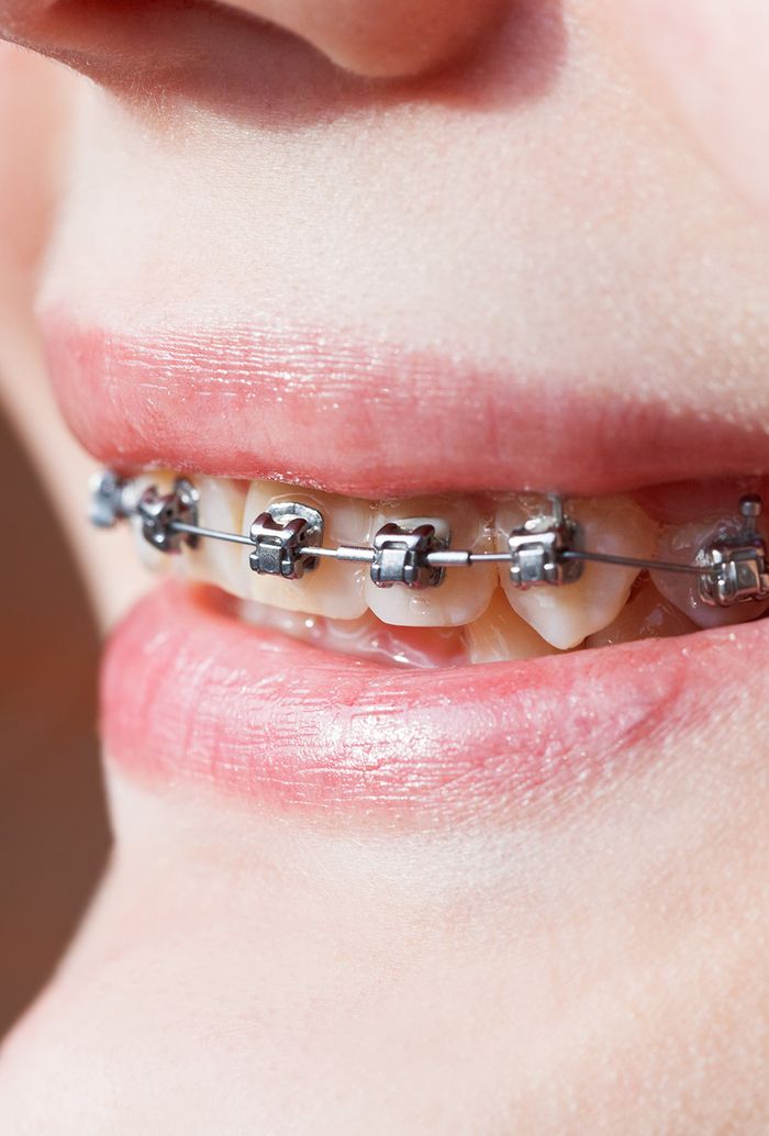 Band-Free Braces