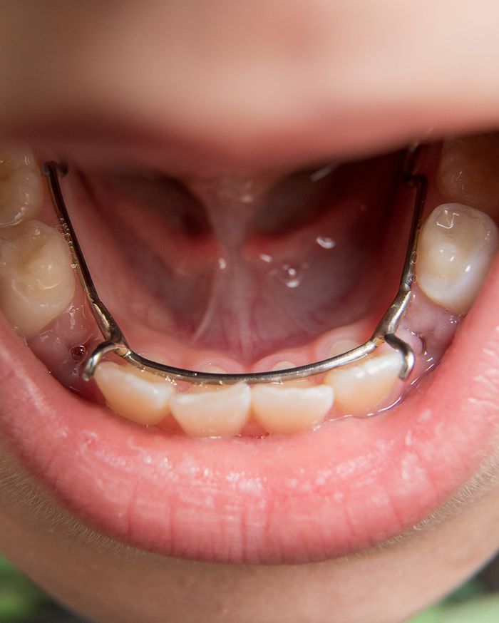 Removable Space Maintainers